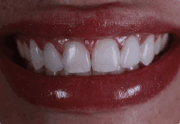 Foto dos dentes do paciente antes do serviço